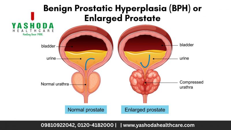 Benign Prostatic Hyperplasia (BPH) or Enlarged Prostate