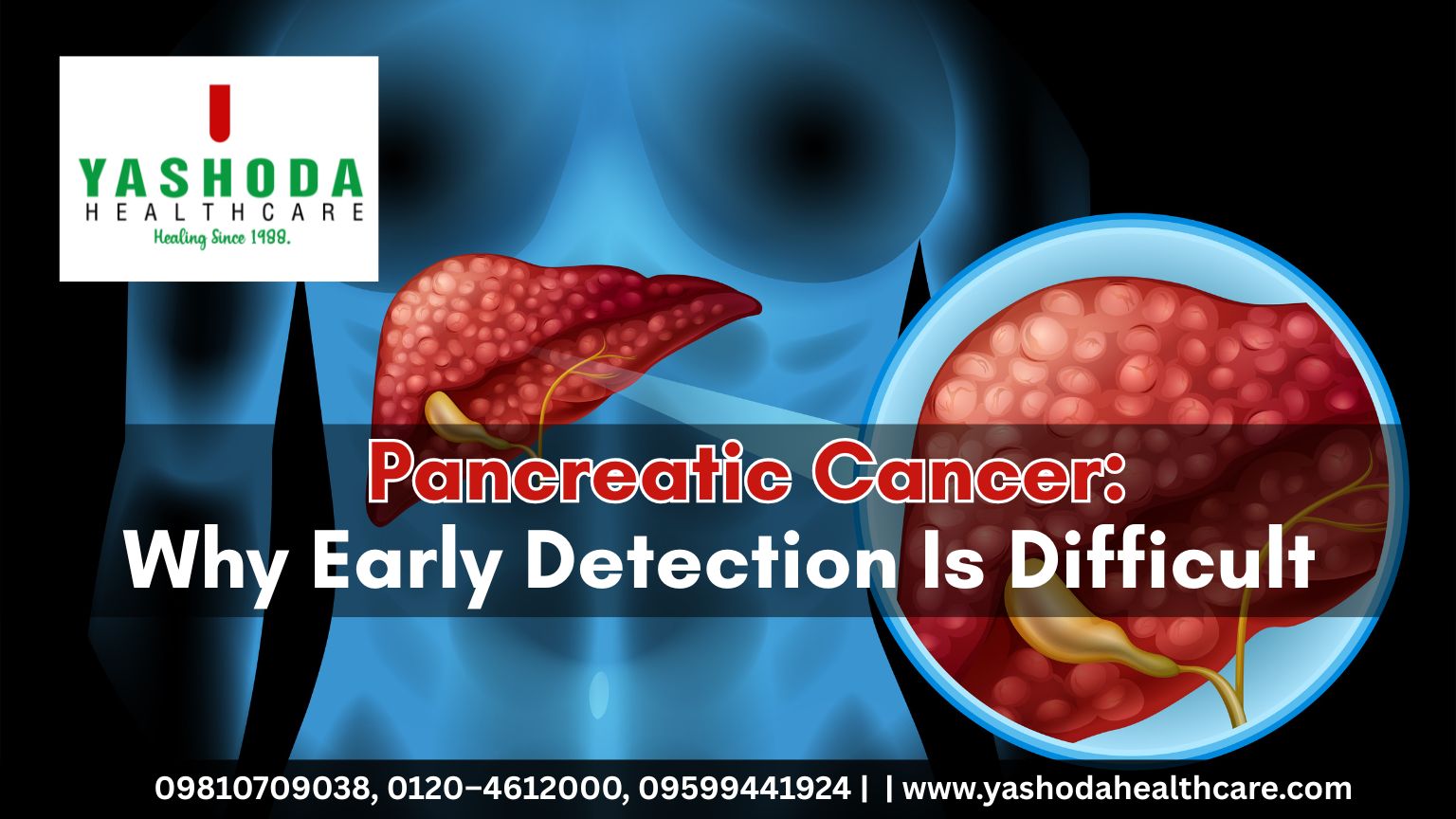 Pancreatic Cancer: Why Early Detection Is Difficult