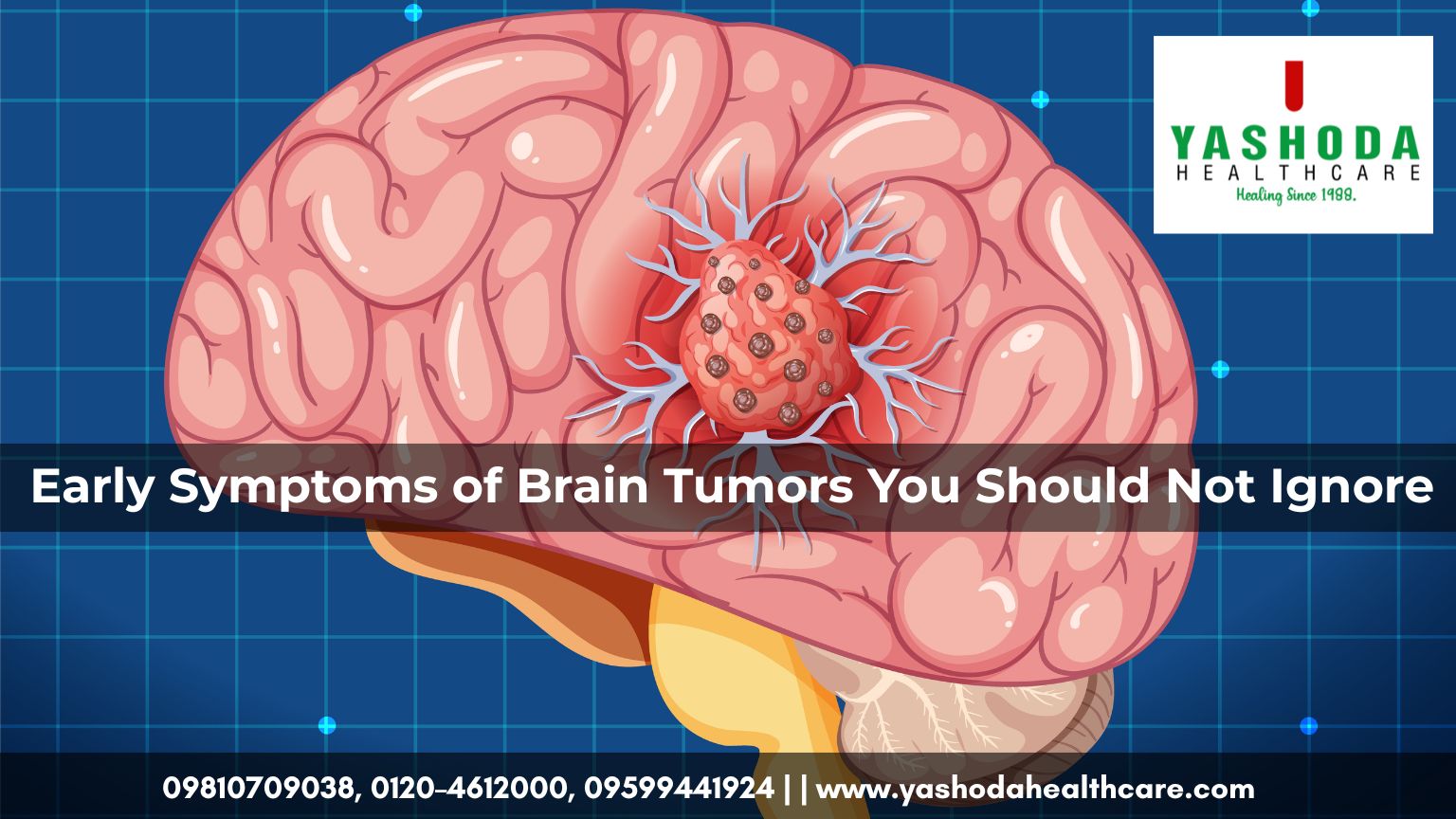 Early Symptoms of Brain Tumors You Should Not Ignore