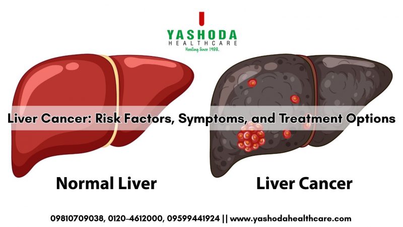 Liver Cancer Risk Factors, Symptoms, and Treatment Options