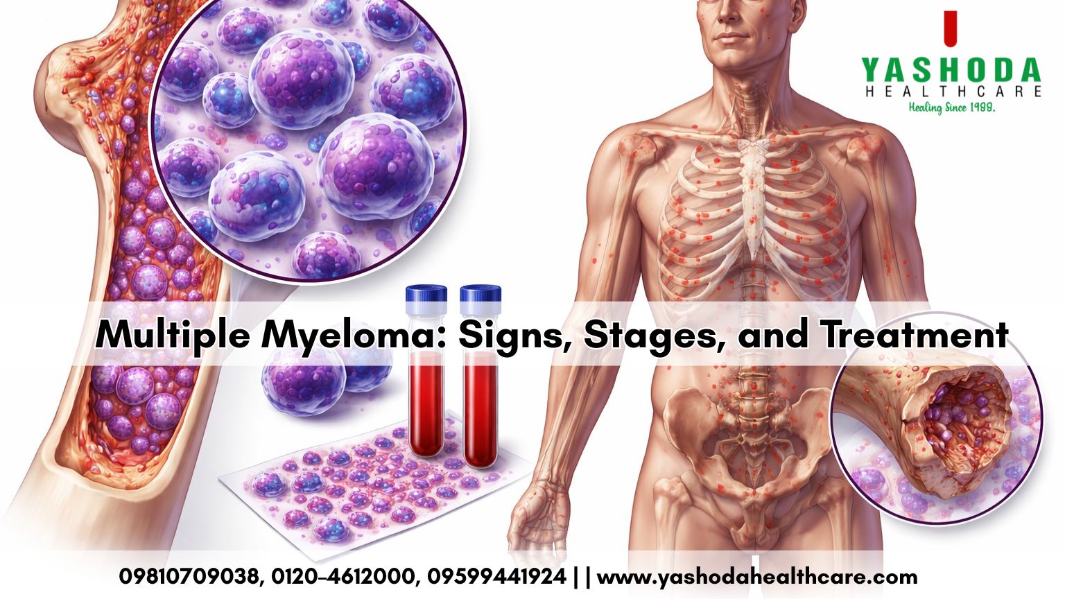 Multiple Myeloma: Signs, Stages, and Treatment Explained