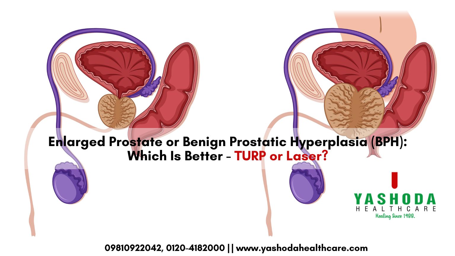 Enlarged Prostate or Benign Prostatic Hyperplasia (BPH): Which Is Better – TURP or Laser?