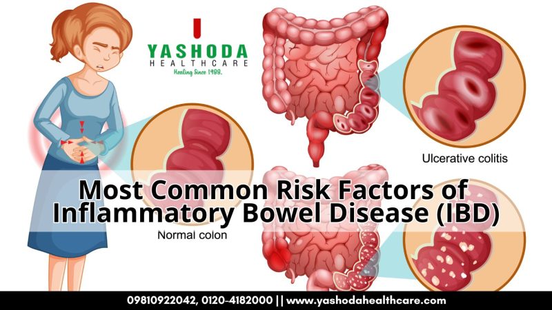 Most Common Risk Factors of Inflammatory Bowel Disease (IBD)
