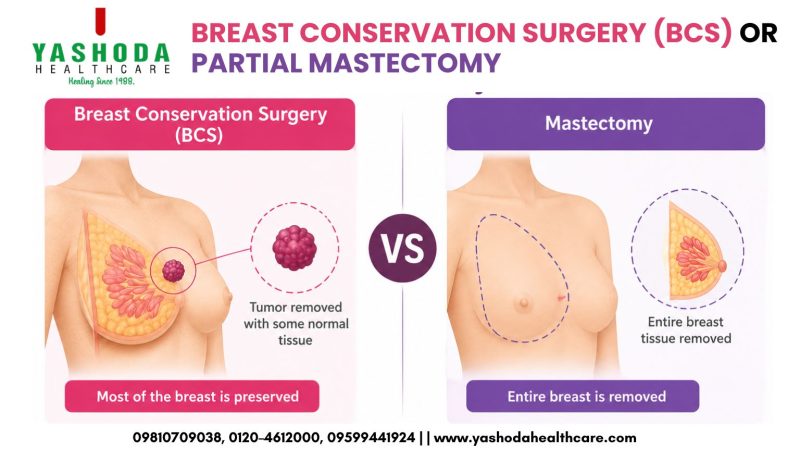 BREAST CONSERVATION SURGERY (BCS) OR PARTIAL MASTECTOMY