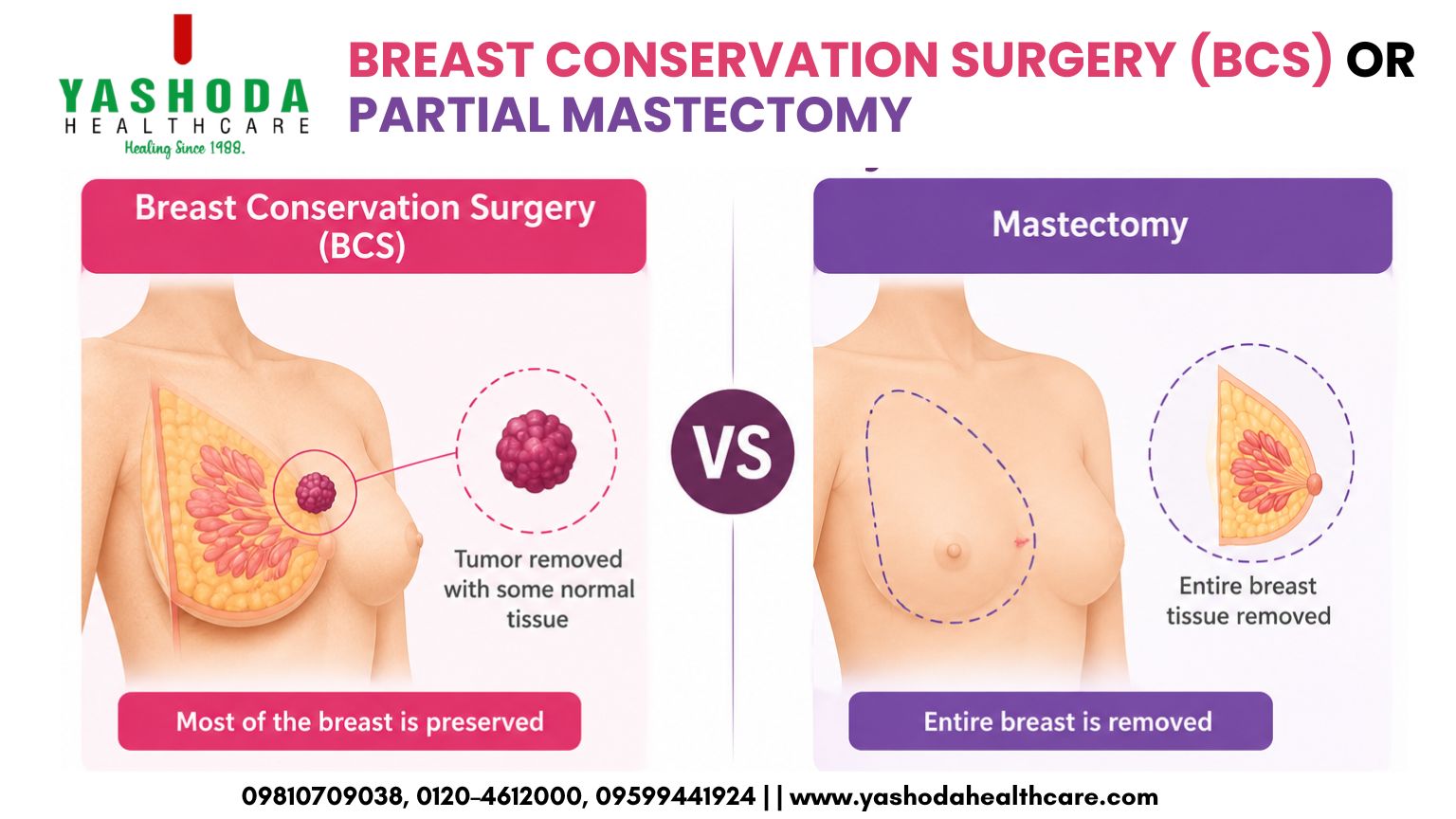 ALL ABOUT BREAST CONSERVATION SURGERY (BCS) OR PARTIAL MASTECTOMY: