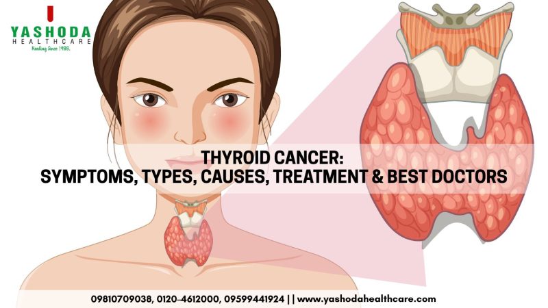Thyroid Cancer
