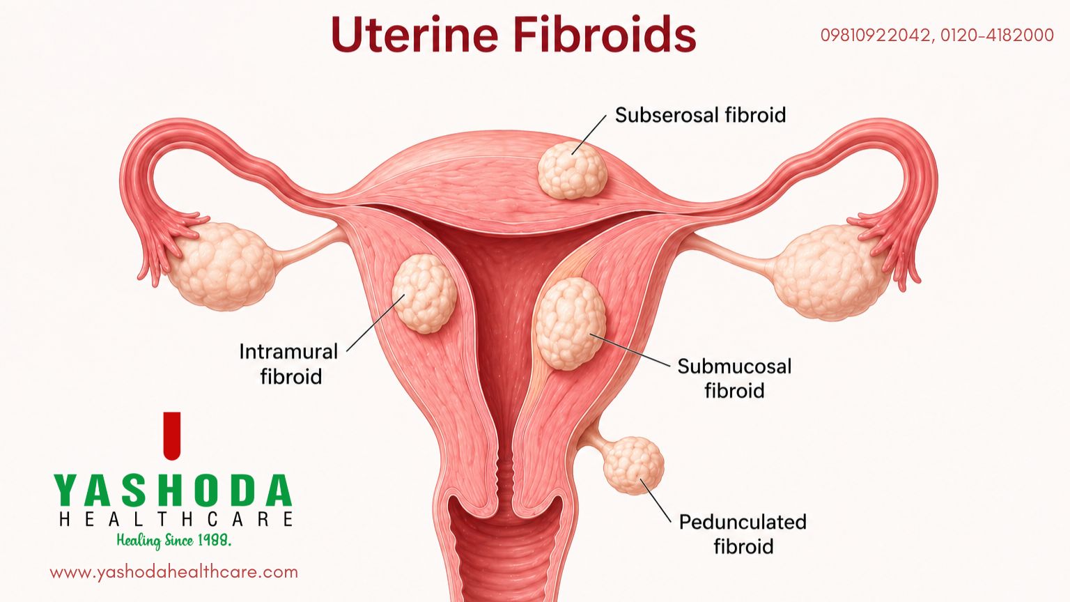 Everything About Uterine Fibroids You Want to Know – From Diagnosis to Treatment