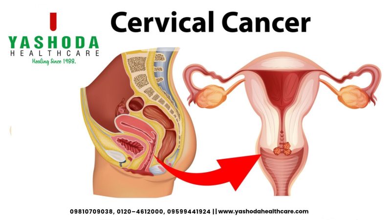 Cervical Cancer