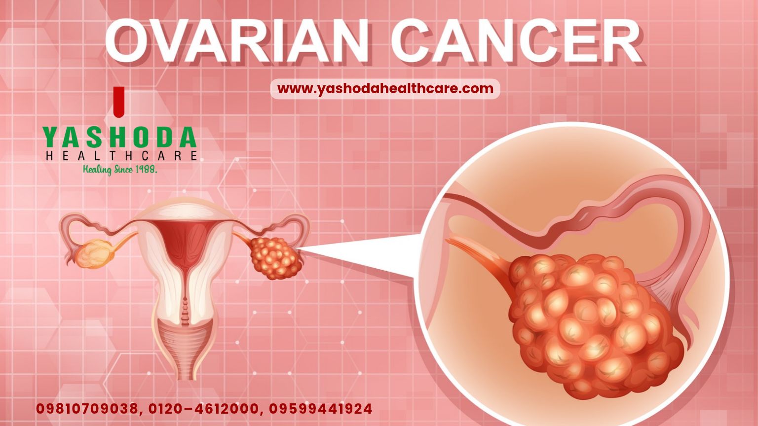 Ovarian Cancer: Signs & Symptoms, Causes & Treatment Options