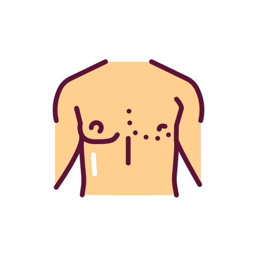 Gynecomastia Surgery
