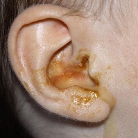 Yellow discharge from the ear