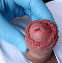 Soreness or redness in the penis