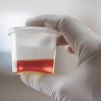 Traces of blood in the urine