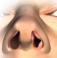 Obstruction in the nostrils