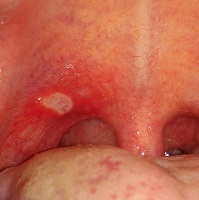 White or yellowish patches on the tonsils