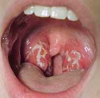 Soreness in the throat