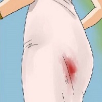 Heavy bleeding during periods