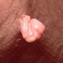 Small lump or skin tag