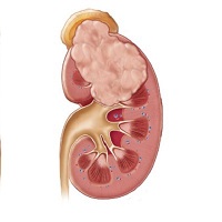 Underlying medical conditions like renal cancer