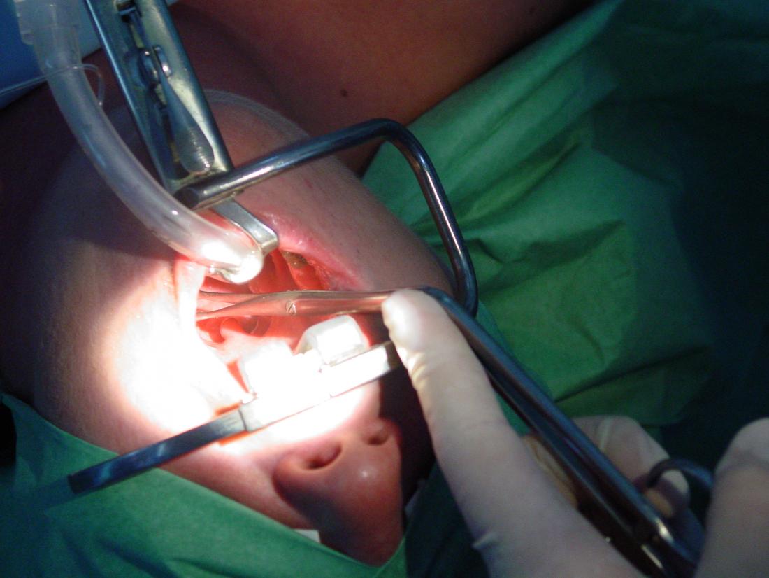 Tonsil Surgery 