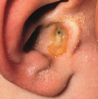 Infection in the ear