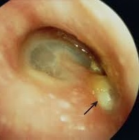 Chronic ear infection