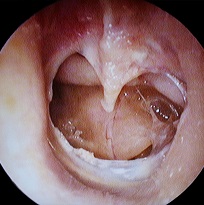 Eardrum injury sustained in an accident