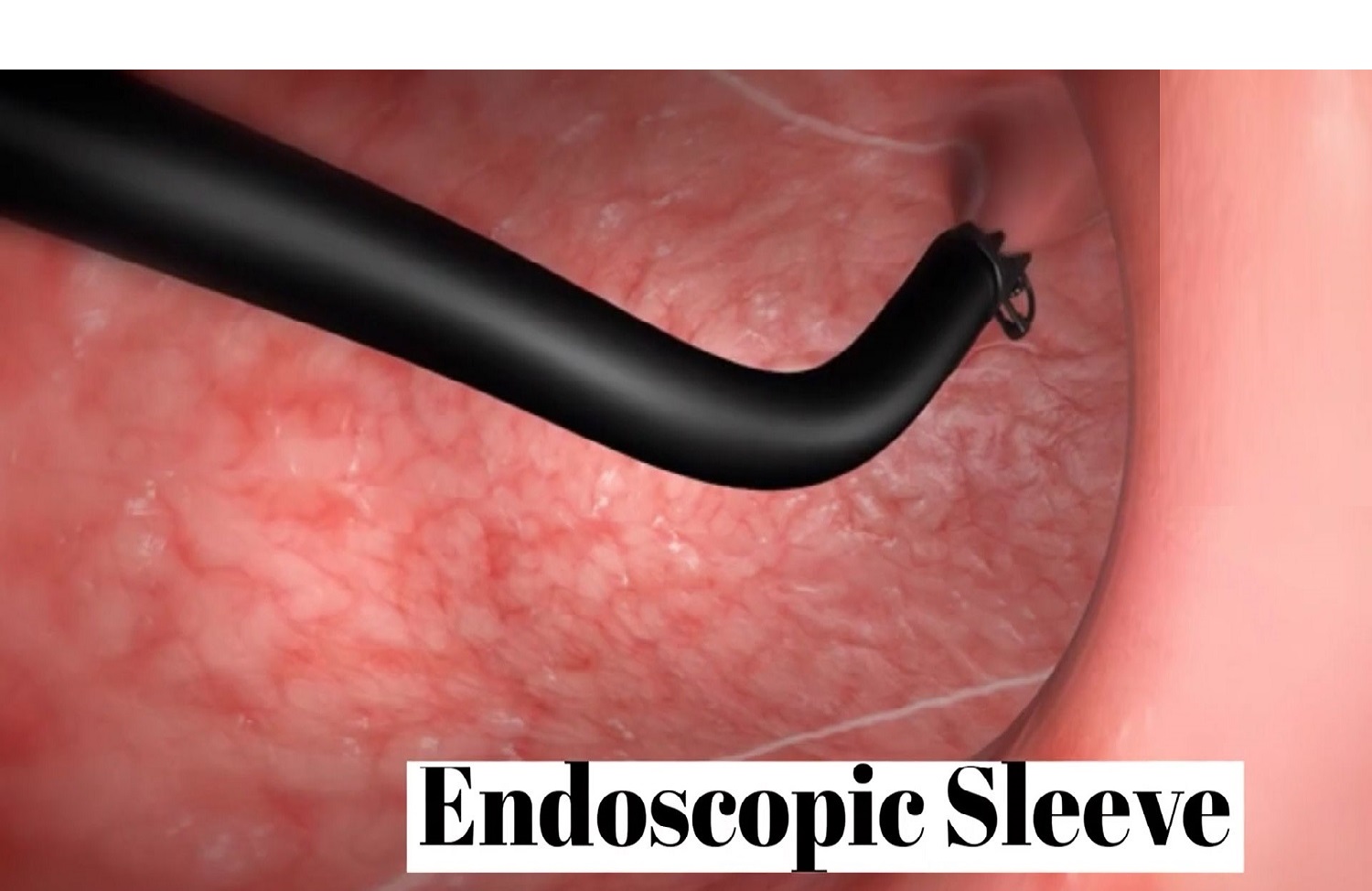 endoscopic-sleeve-surgery
