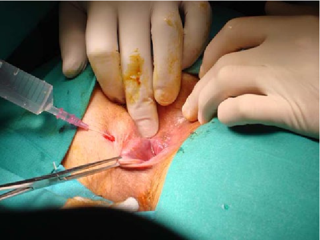 fistula-treatment-surgery